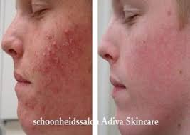 acne schoonheidsspecialist