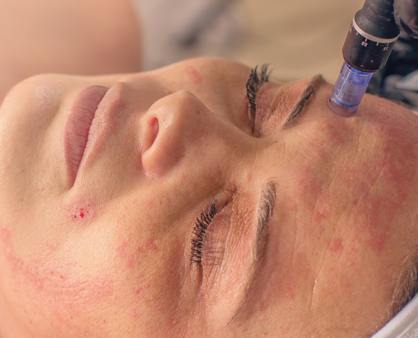Professionele Microneedling Behandelingen bij Ervaren Schoonheidsspecialist